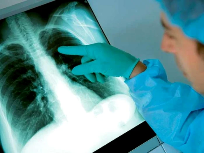 Analize-gratuite-n-16-comune-pentru-depistarea-tuberculozei-Judeul-Clrai-are-printre-cele-mai-multe-cazuri
