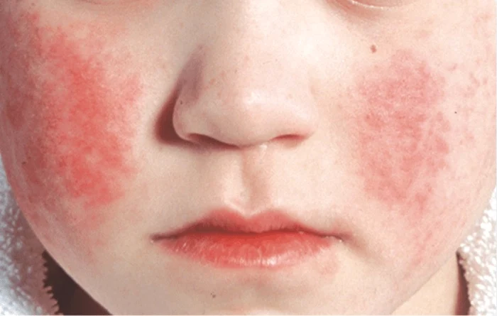 Bolnavul-care-arat-ca-fiind-plmuit-Afeciunea-are-o-contagiozitate-de-peste-90