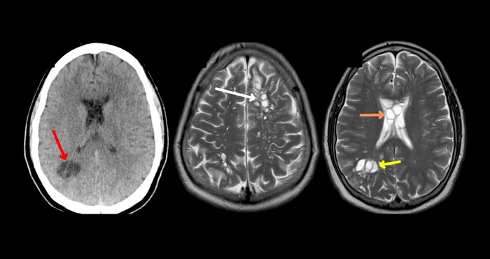 Brbat-din-SUA-ajuns-la-spital-cu-migren-cauzat-de-tenii-Alimentul-care-ar-fi-fost-sursa-infectrii