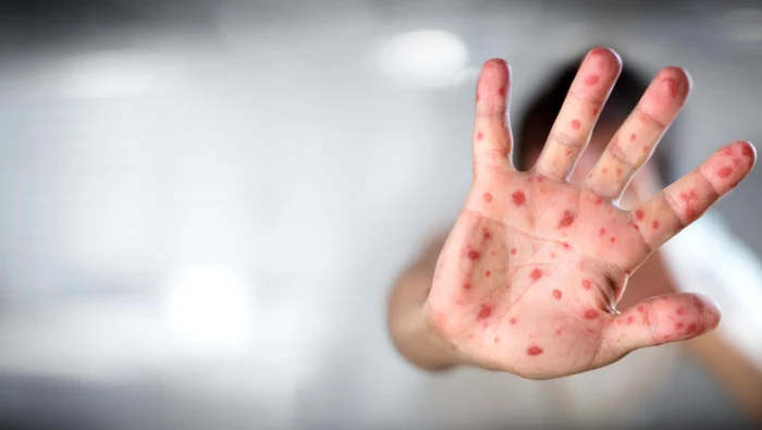 Ghidul-unui-pediatru-despre-rujeol-de-ajutor-prinilor-Situaie-alarmant-n-Romnia-