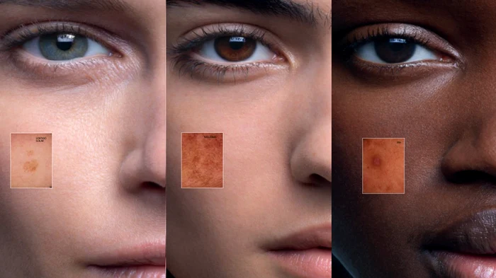 Petele-pigmentare--de-ce-apar-cum-le-tratm-i-cum-putem-preveni-reapariia-acestora