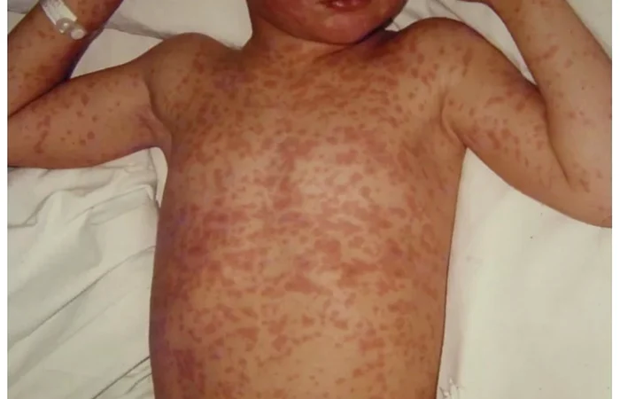 Renumit-medic-pediatru-avertisment-Tocmai-am-vzut-un-caz-sever-de-rujeol-boal-care-cred-unii-nu-exist