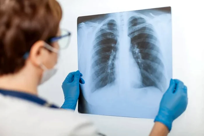 Tratament-nou-pentru-pacienii-cu-cancer-pulmonar-n-unele-cazuri-medicamentul-oprete-metastazele-i-evoluia-bolii