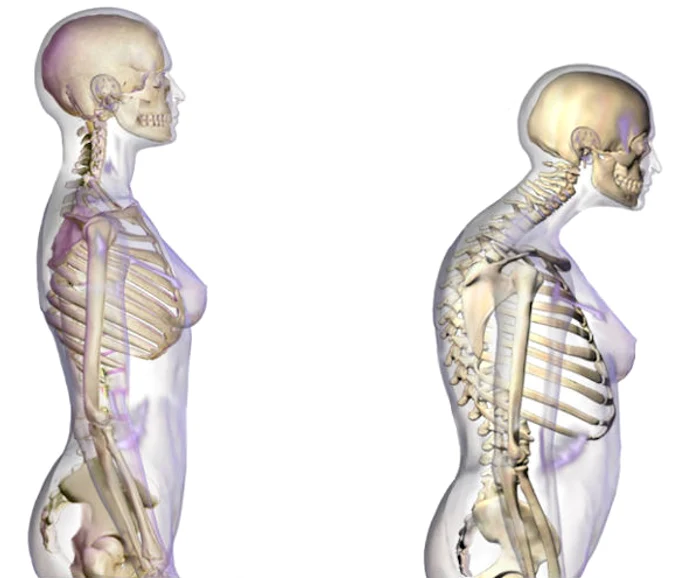 De-ce-osteoporoza-este-mai-frecvent-la-femei-dect-la-brbai-Alimentele-ce-trebuie-introduse-n-diet