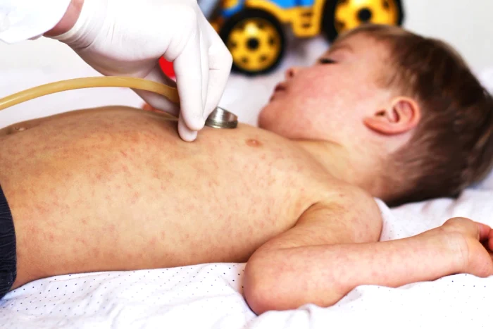 Peste-760-de-cazuri-noi-de-rujeol-n-ultima-sptmn-Un-bebelu-din-Bucureti-nevaccinat-a-murit-