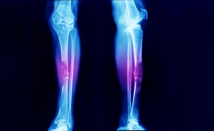 O-substan-injectabil-gelatinoas-soluie-pentru-vindecarea-articulaiilor-fr-intervenie-chirurgical-Ar-putea-trata-inclusiv-osteoartrita-
