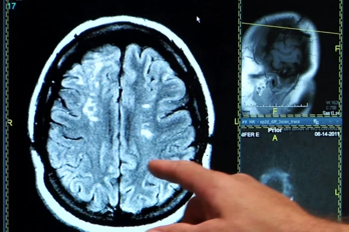 ---------O-procedur-revolutionar-care-deblocheaz-circulaia-cerebral-va-fi-folosit-la-un-spital-din-Moldova-Cresc-ansele-de-recuperare-complet