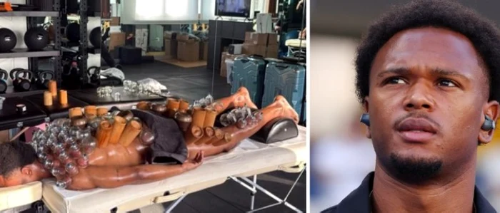 ---------Imagine-nfricotoare-un-fotbalist-belgian-i-a-umplut-spatele-cu-ventuze-Ce-este-cuppingul