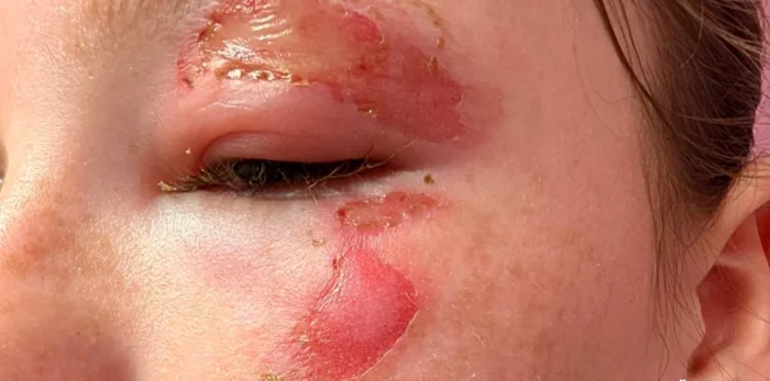 Copii cu arsuri grave după ce au încălzit în microunde jucării „squishy” văzute pe TikTok; medici trag un semnal de alarmă