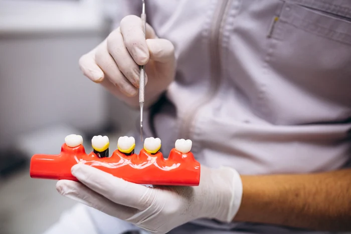 Implant dentar în prezența parodontozei: când este posibil și ce pași sunt necesari