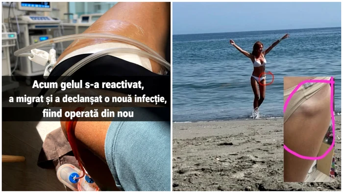 „Aquafilling-ul poate ucide”, avertizează o avocată din Galați după aproape 30 de operații