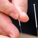 O femeie din Siberia a ajuns la spital după acupunctură: peste zece fragmente de ace, înfipte în picior