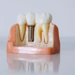 Când este sigură încărcarea imediată a implanturilor dentare: criterii și limite