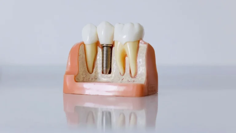 Când este sigură încărcarea imediată a implanturilor dentare: criterii și limite