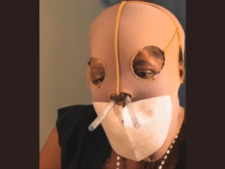Femeie atacată cu acid în 2000 cere eutanasia după 87 de operații: povestea Maríei Consuelo Córdoba