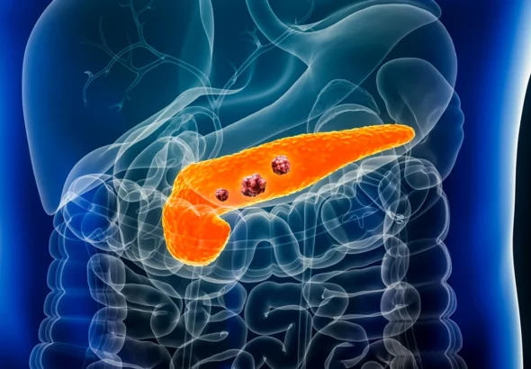 Tratament experimental oral a redus tumorile la 9 din 22 pacienți cu cancer pancreatic metastatic
