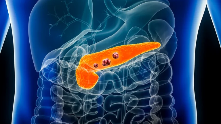 Tratament experimental oral a redus tumorile la 9 din 22 pacienți cu cancer pancreatic metastatic
