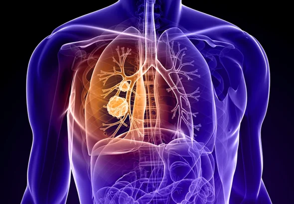 Nouă combinație terapeutică reduce riscul de deces cu 58% la cancerul pulmonar cu celule mici