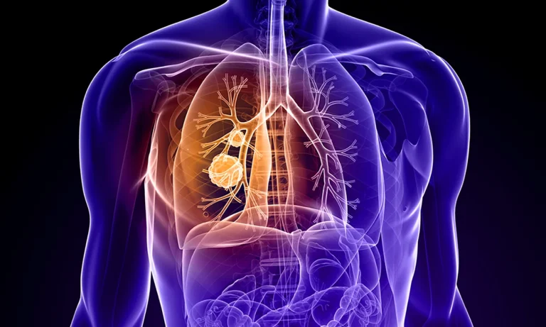 Nouă combinație terapeutică reduce riscul de deces cu 58% la cancerul pulmonar cu celule mici