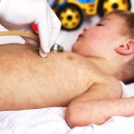 Stare de urgență în New York din cauza unui focar de rujeolă; guvernatorul extinde administrarea vaccinului ROR