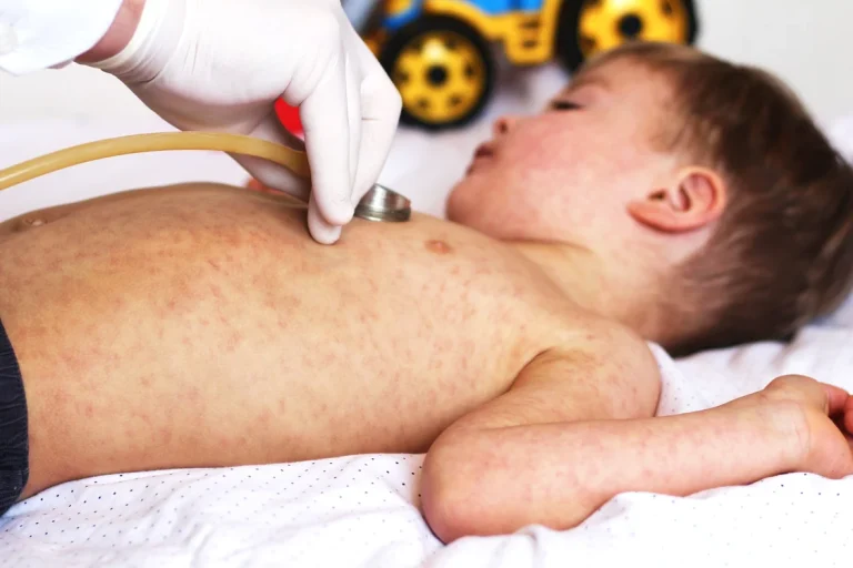 Stare de urgență în New York din cauza unui focar de rujeolă; guvernatorul extinde administrarea vaccinului ROR